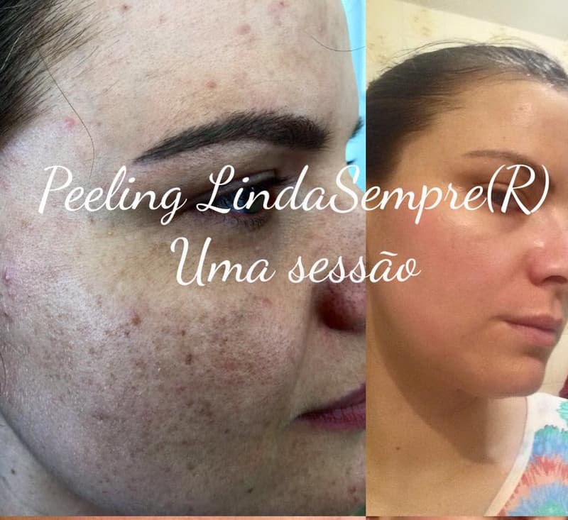 Reserva de Peeling — Cuiabá 2